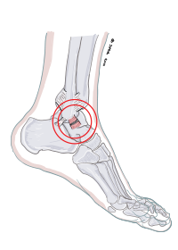 Ligamentskada fotled